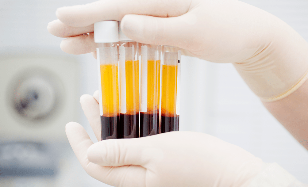 Verihiutalerikas plasma niveltulehduksen PRP-hoitoon